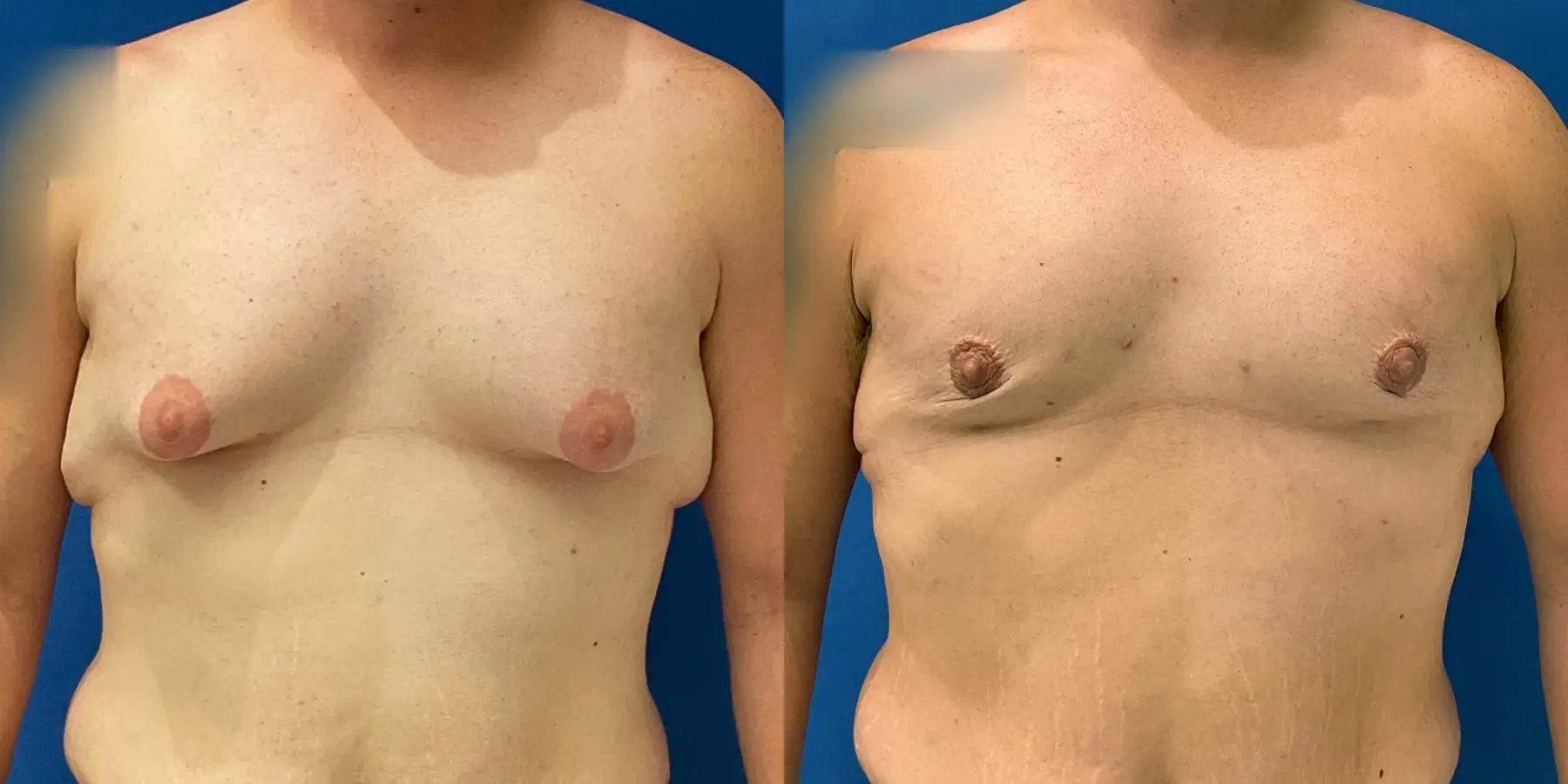 Male Breast Reduction: Patient 7 - Before and After 1