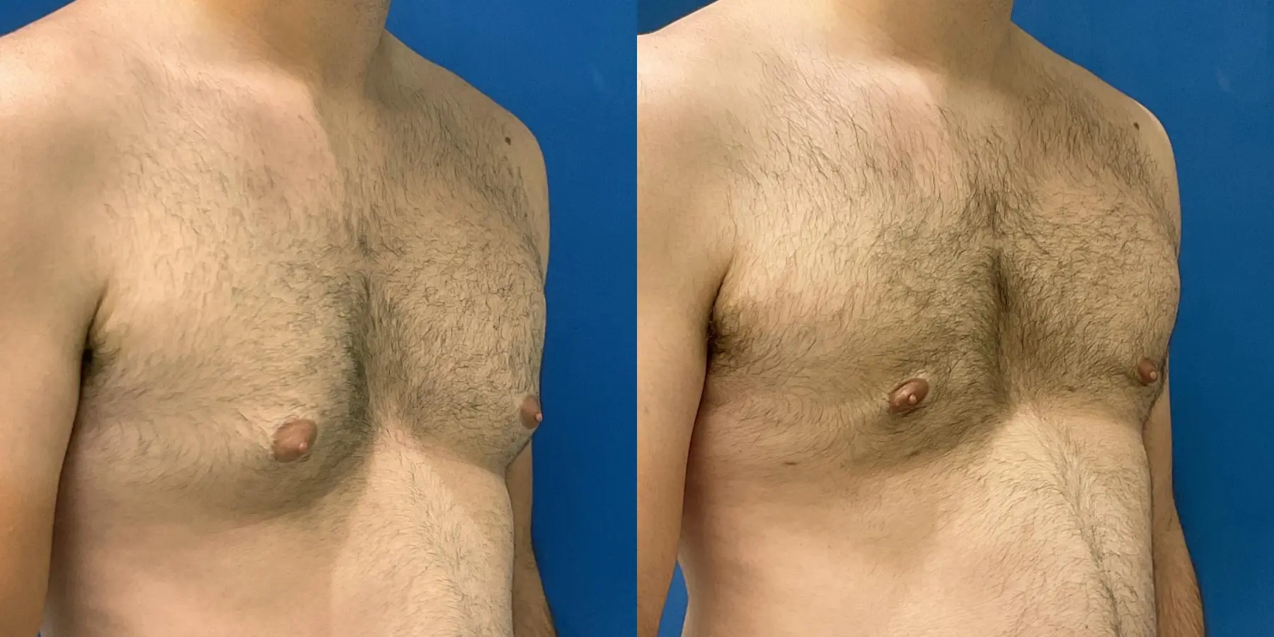 Male Breast Reduction: Patient 5 - Before and After 3