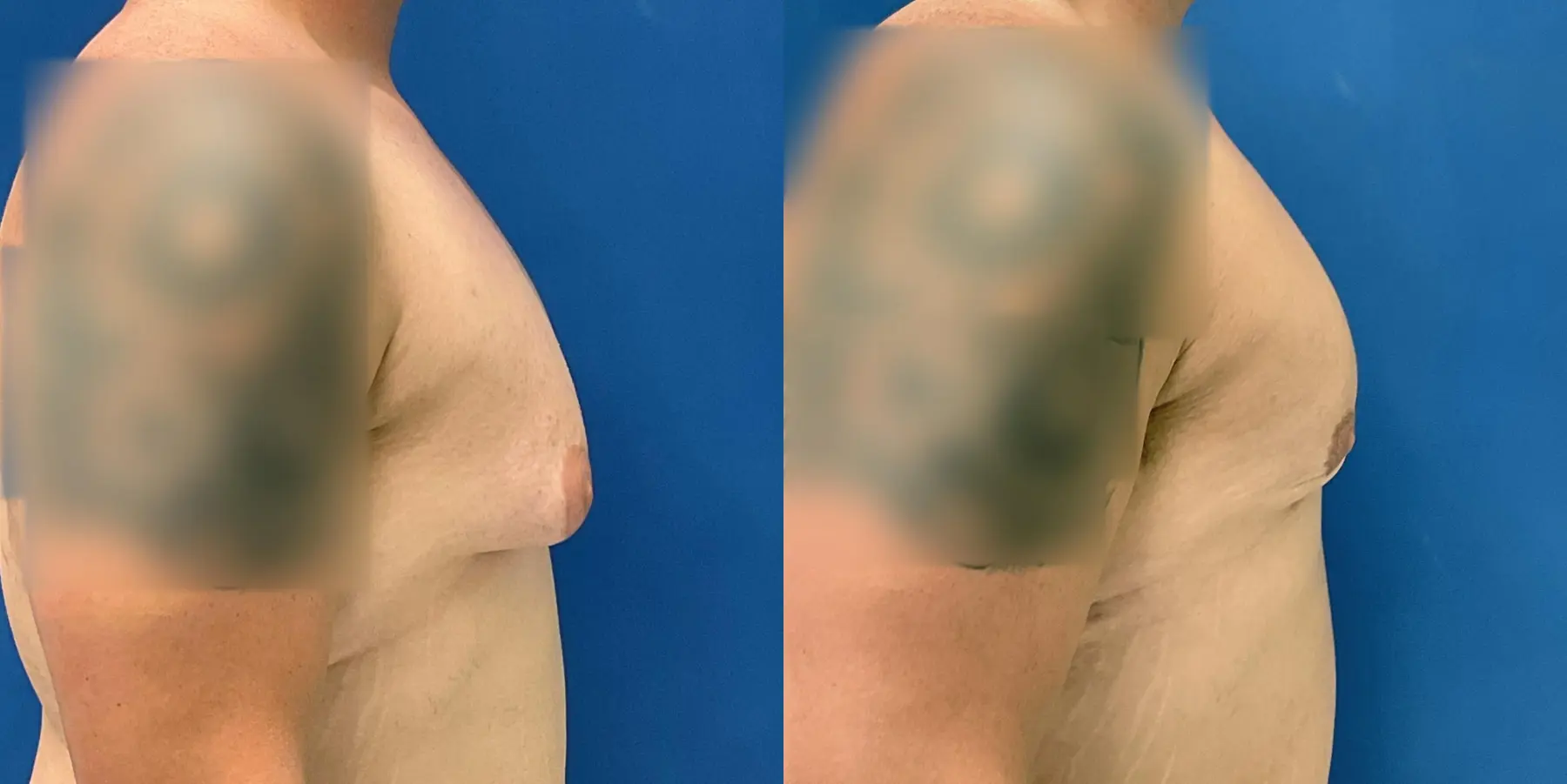 Male Breast Reduction: Patient 7 - Before and After 5