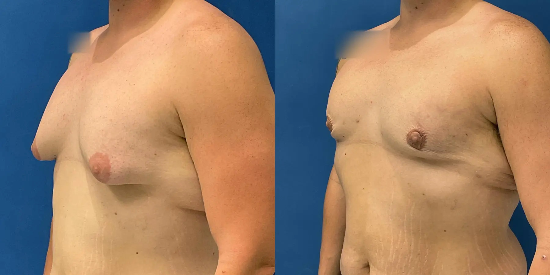 Male Breast Reduction: Patient 7 - Before and After 2