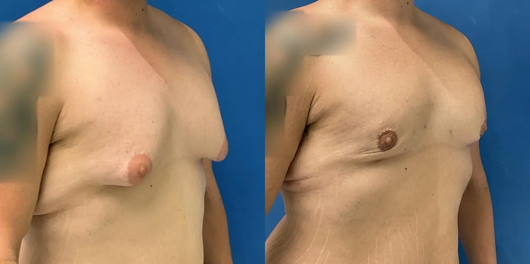 Male Breast Reduction: Patient 7 - Before and After 3