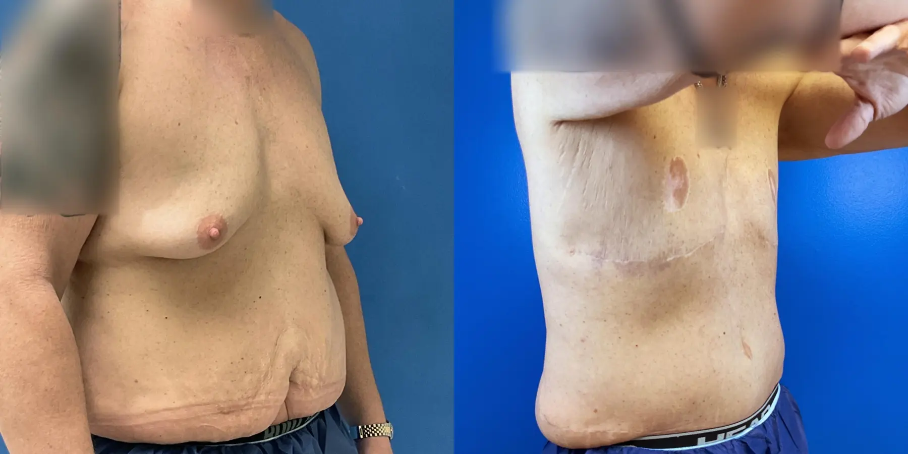 Male Breast Reduction: Patient 6 - Before and After 3