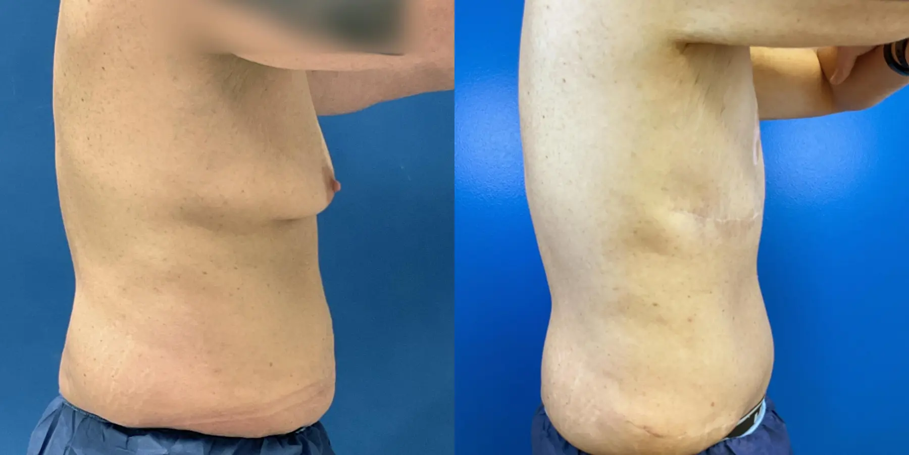 Male Breast Reduction: Patient 6 - Before and After 5