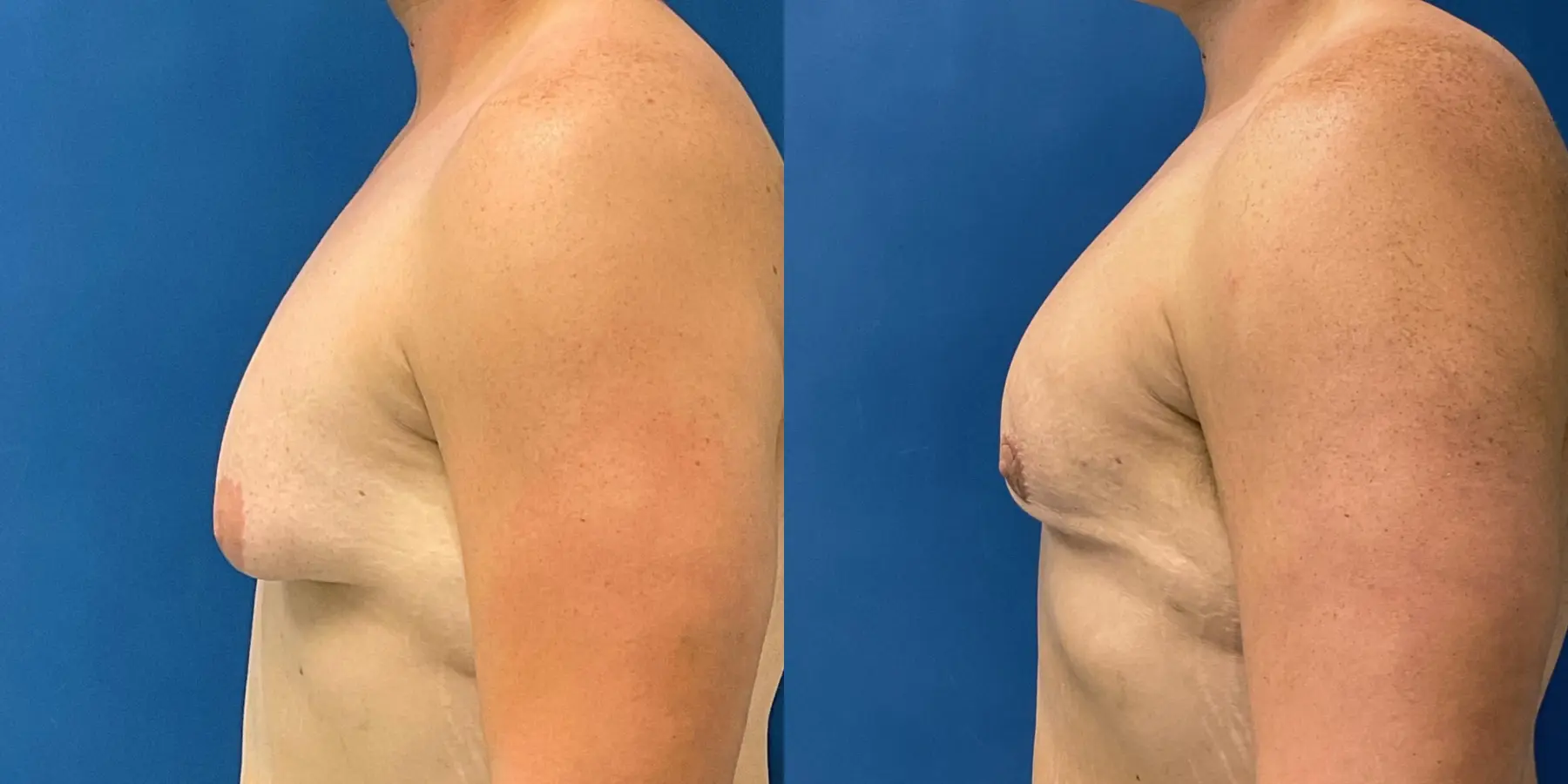 Male Breast Reduction: Patient 7 - Before and After 4