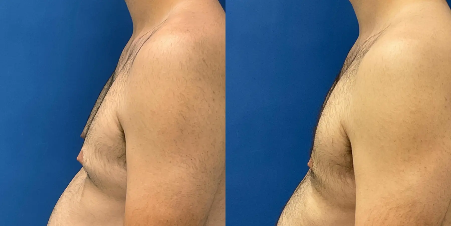 Male Breast Reduction: Patient 5 - Before and After 4