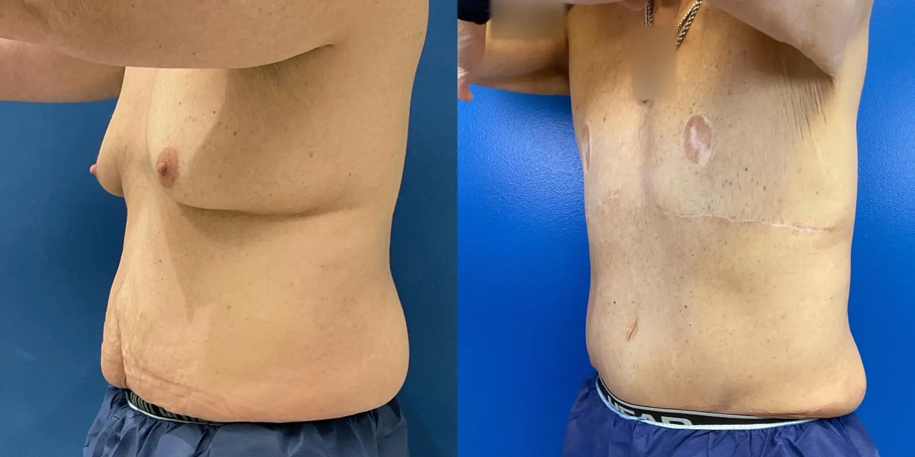 Male Breast Reduction: Patient 6 - Before and After 2