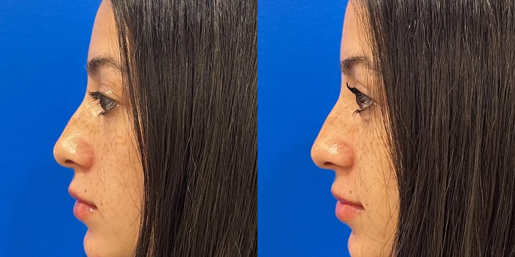 Permanent Makeup: Patient 1 - Before and After 3