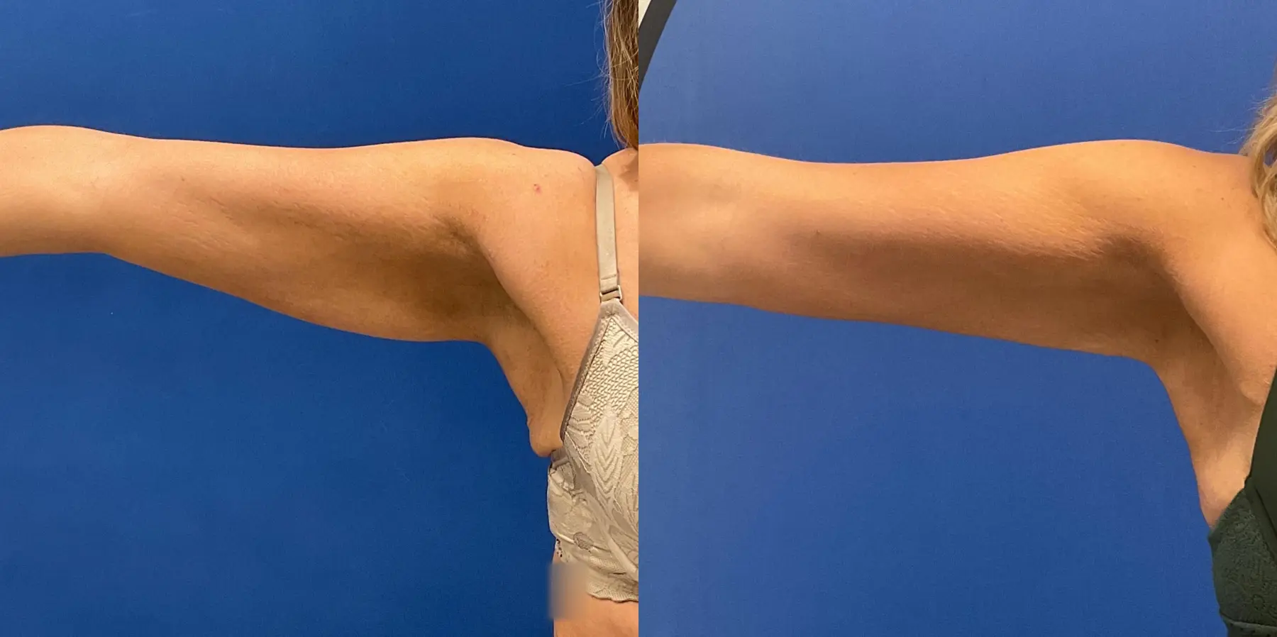 Renuvion: Patient 12 - Before and After 2