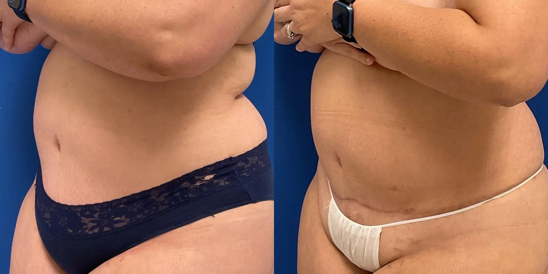 Renuvion: Patient 9 - Before and After 2