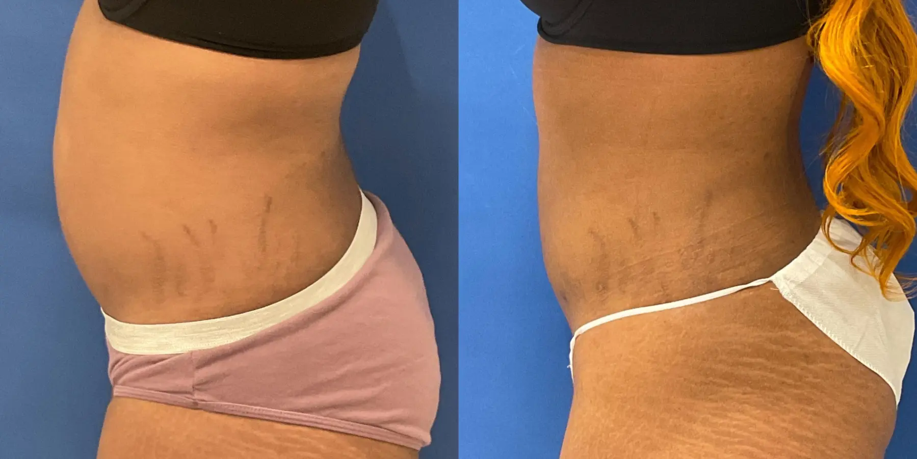 Renuvion: Patient 11 - Before and After 4