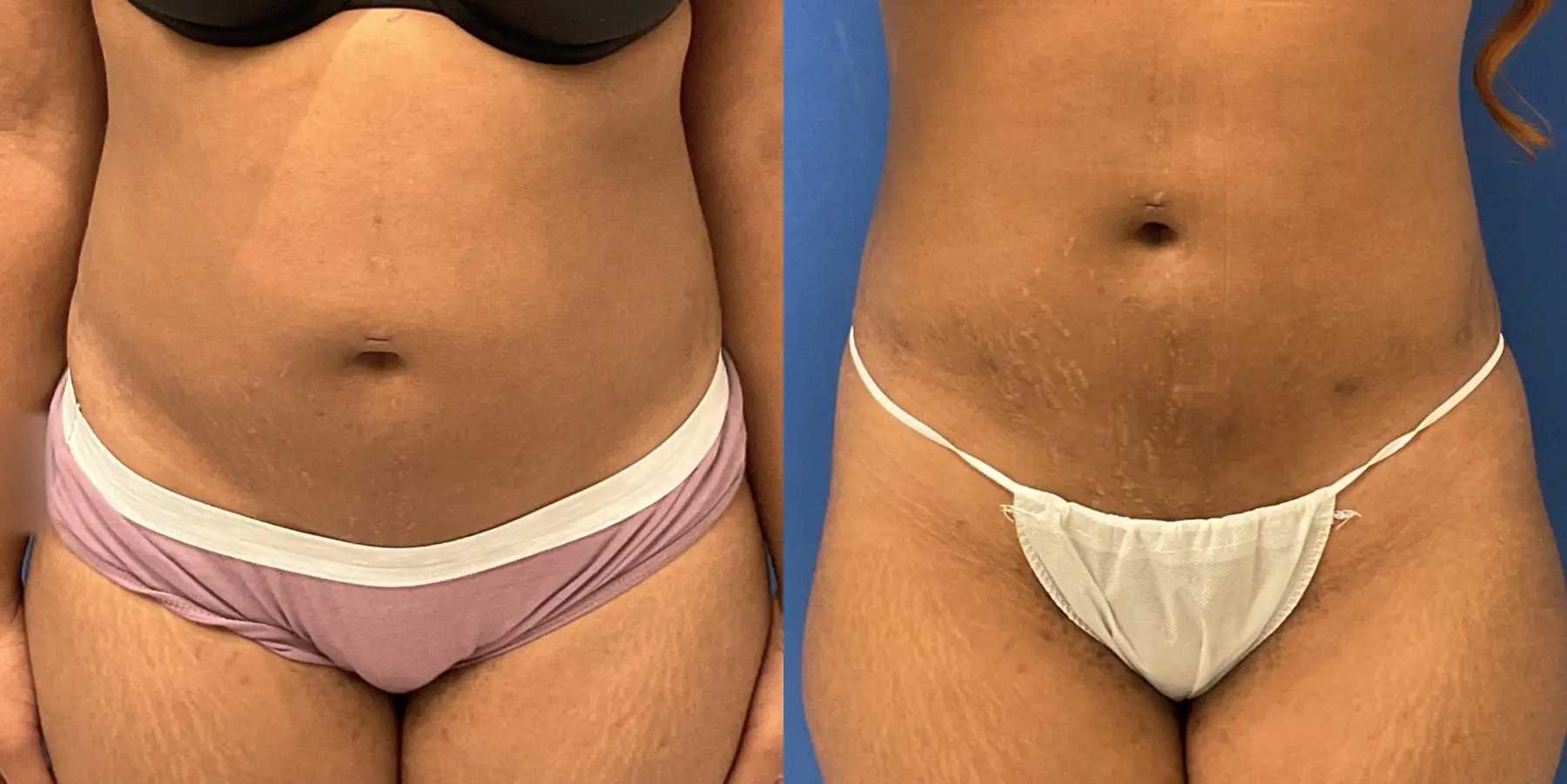 Renuvion: Patient 11 - Before and After 1