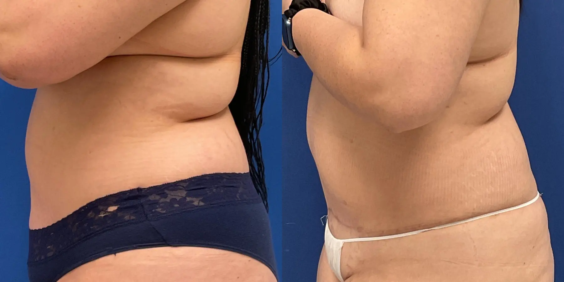 Renuvion: Patient 9 - Before and After 4