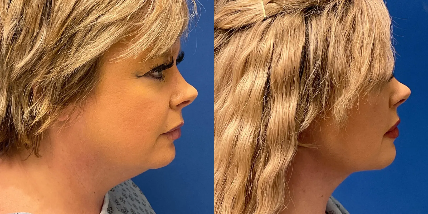 Renuvion Face: Patient 2 - Before and After