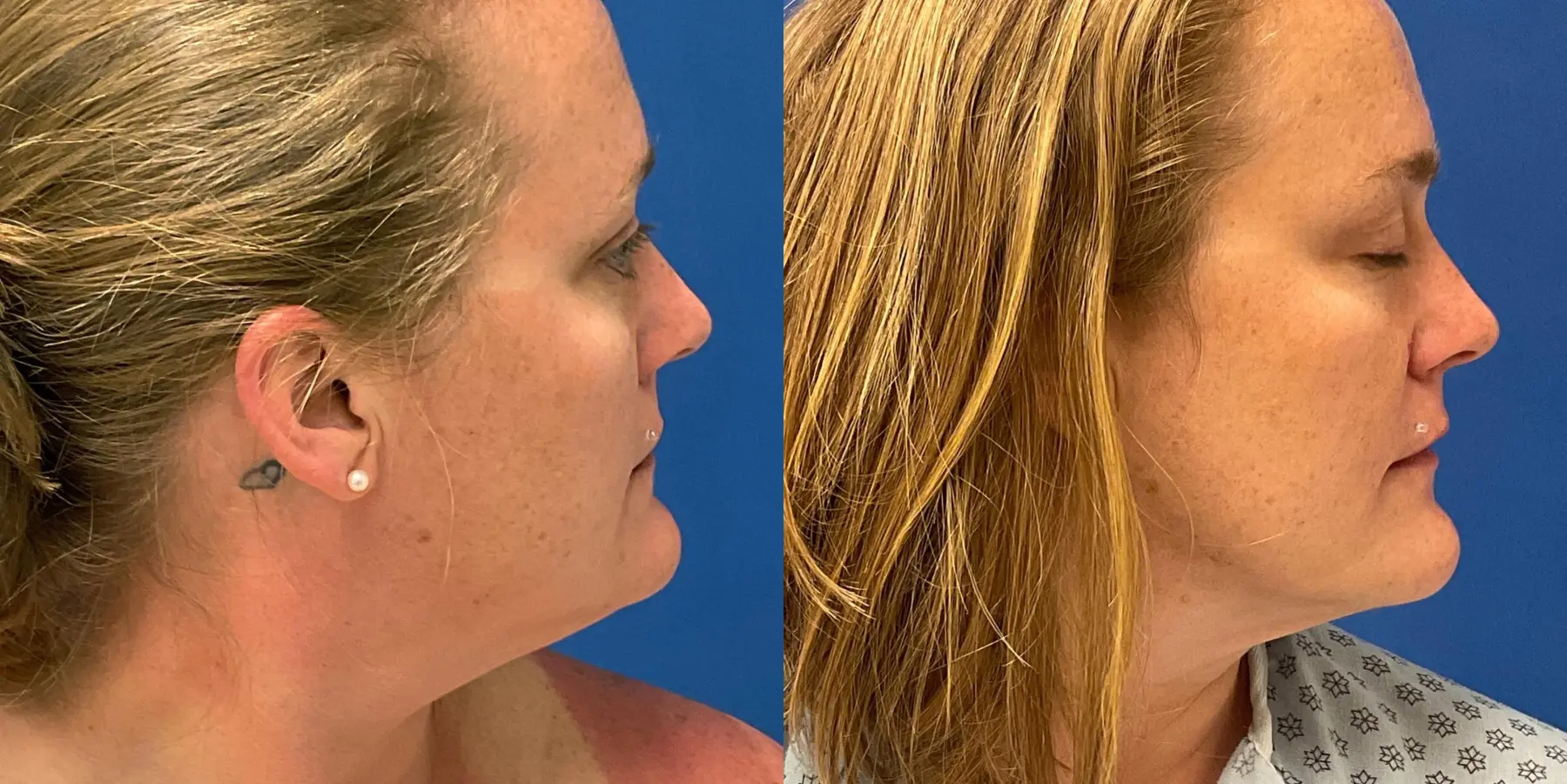 Renuvion Face: Patient 4 - Before and After