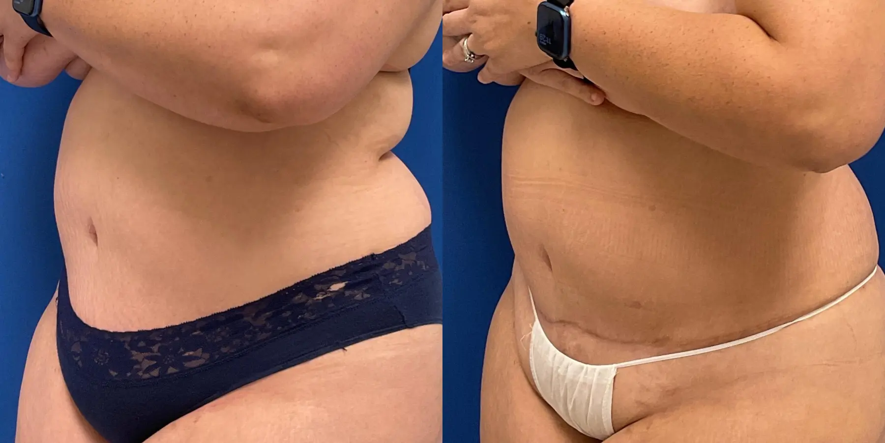 Skin Tightening: Patient 8 - Before and After 2