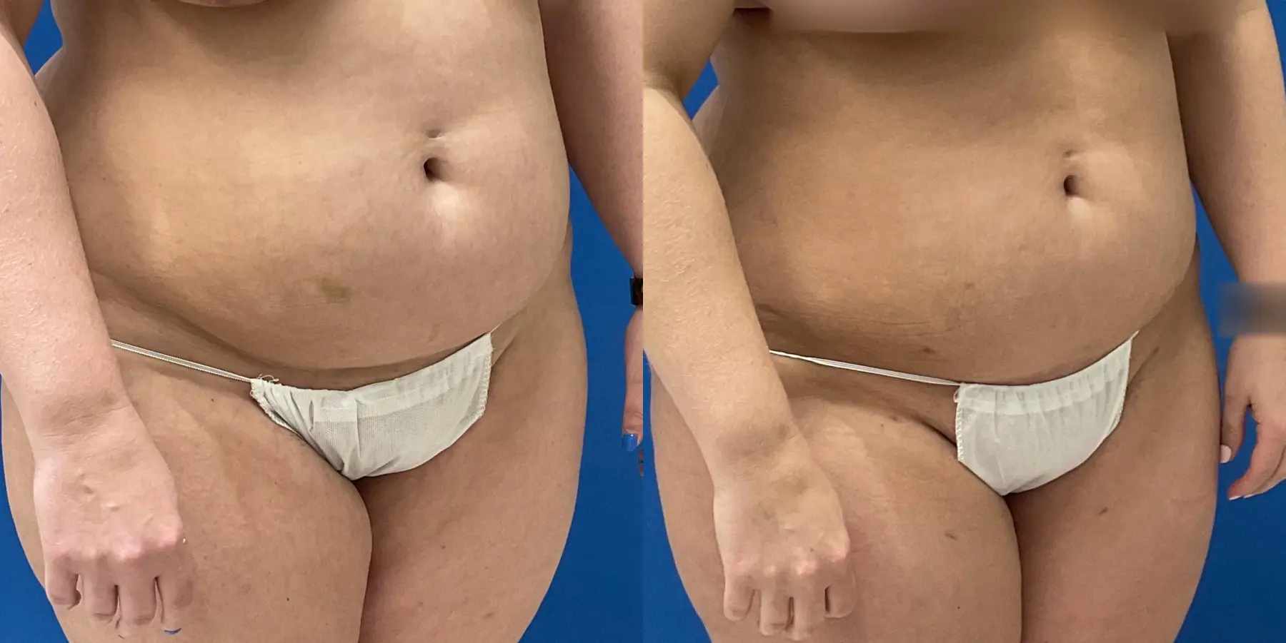 Skin Tightening: Patient 10 - Before and After 3
