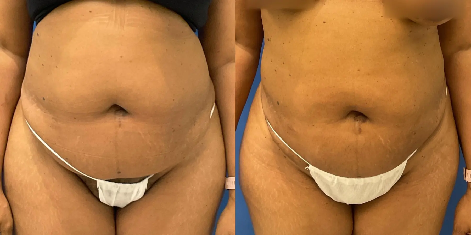 Skin Tightening: Patient 8 - Before and After  