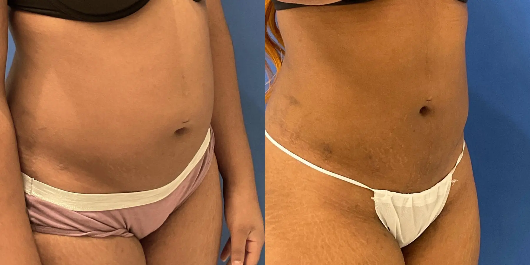 Skin Tightening: Patient 10 - Before and After 3