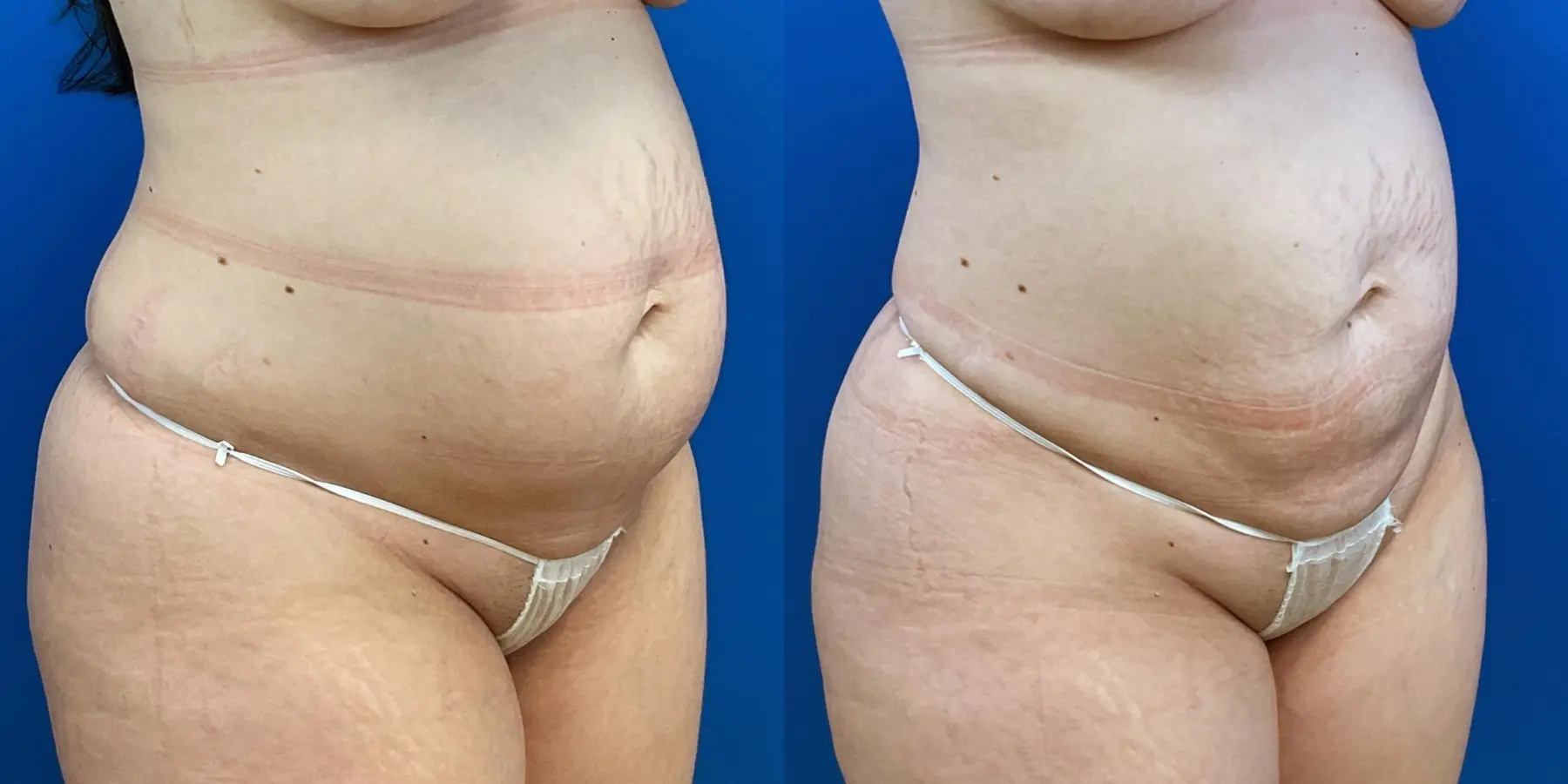 Skin Tightening: Patient 13 - Before and After 3