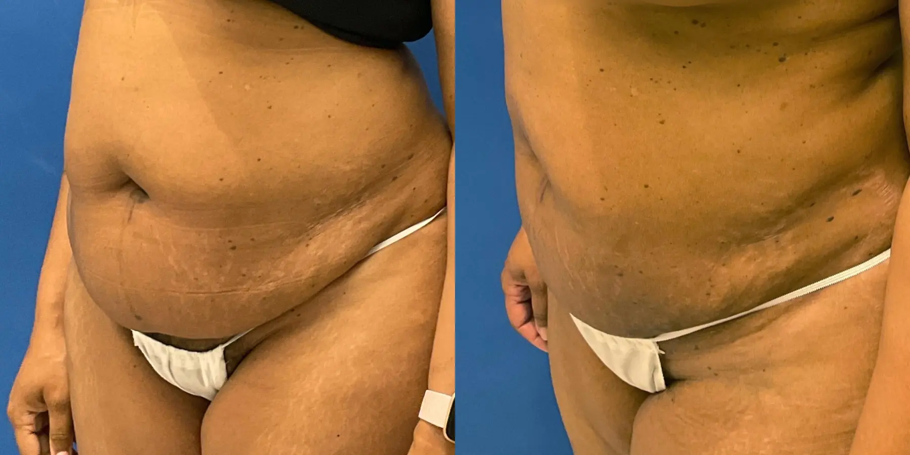 Skin Tightening: Patient 8 - Before and After 2