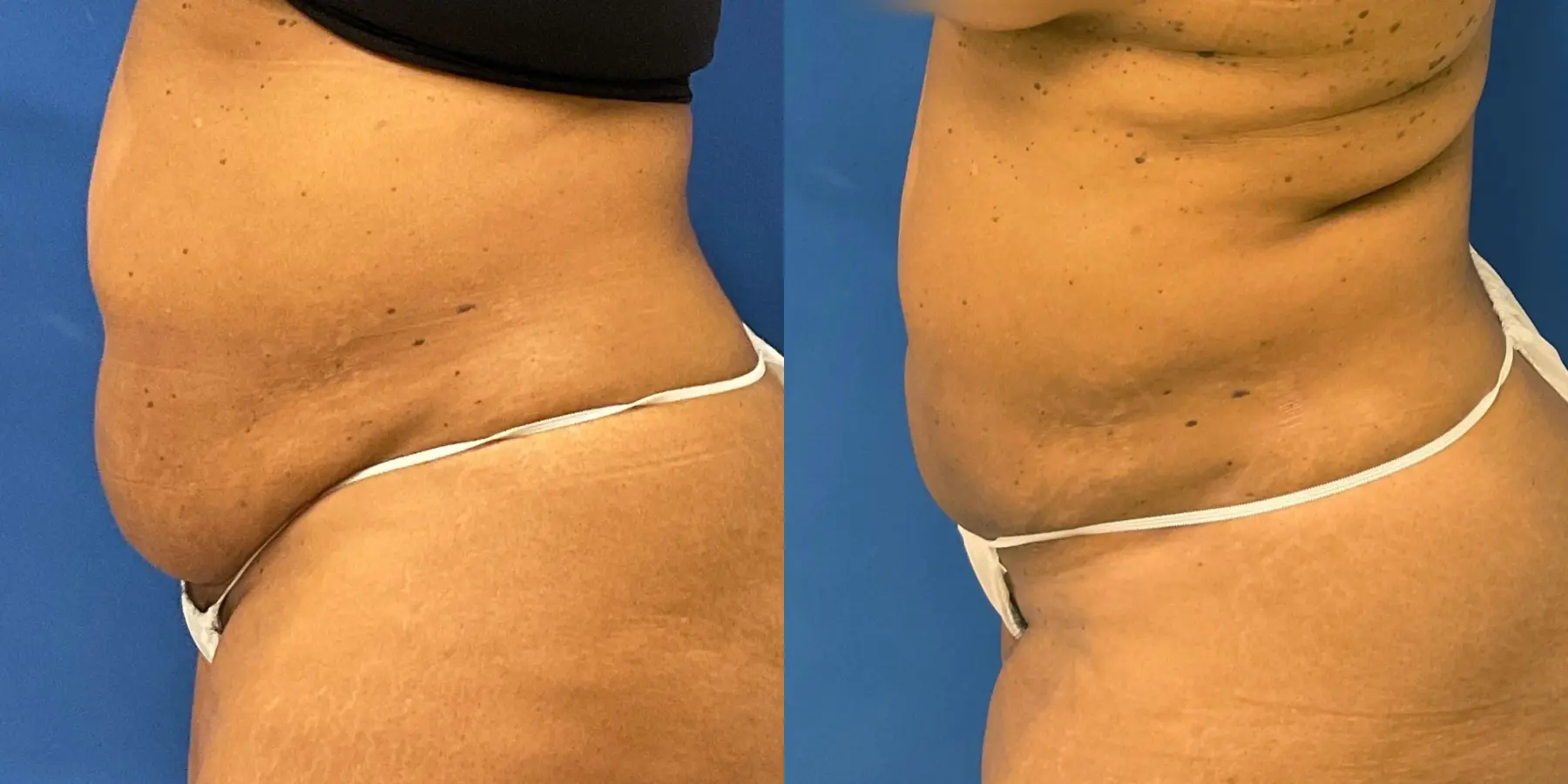 Skin Tightening: Patient 8 - Before and After 4