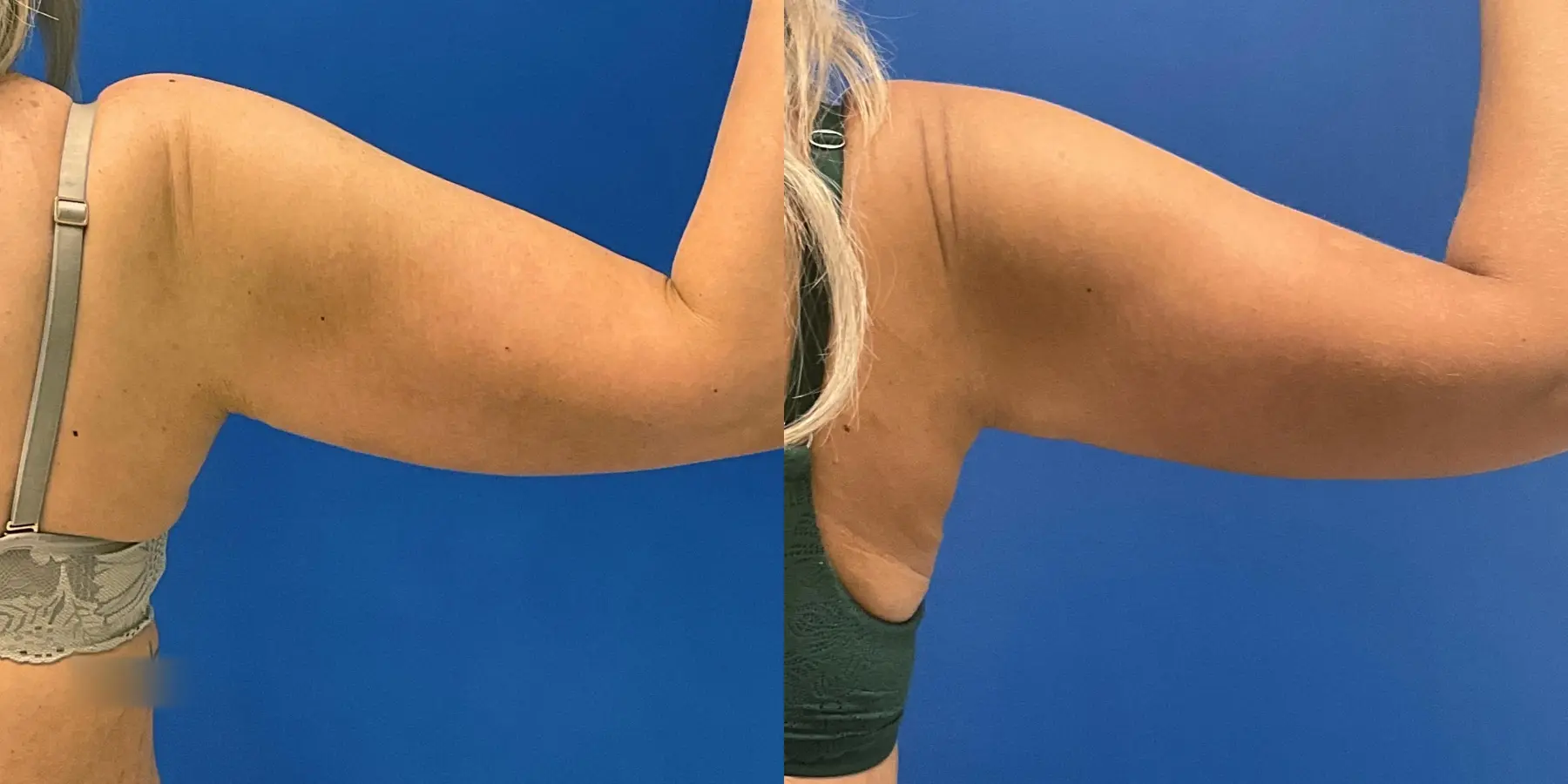 Skin Tightening: Patient 20 - Before and After 4