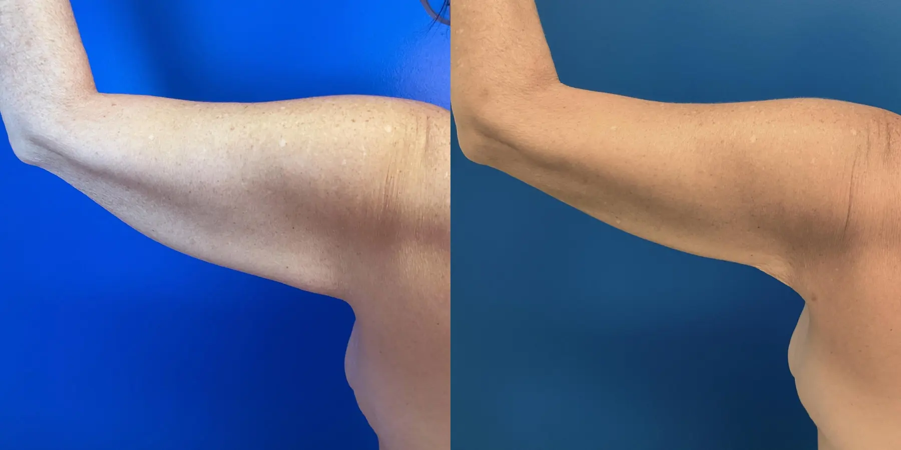 Skin Tightening: Patient 5 - Before and After  