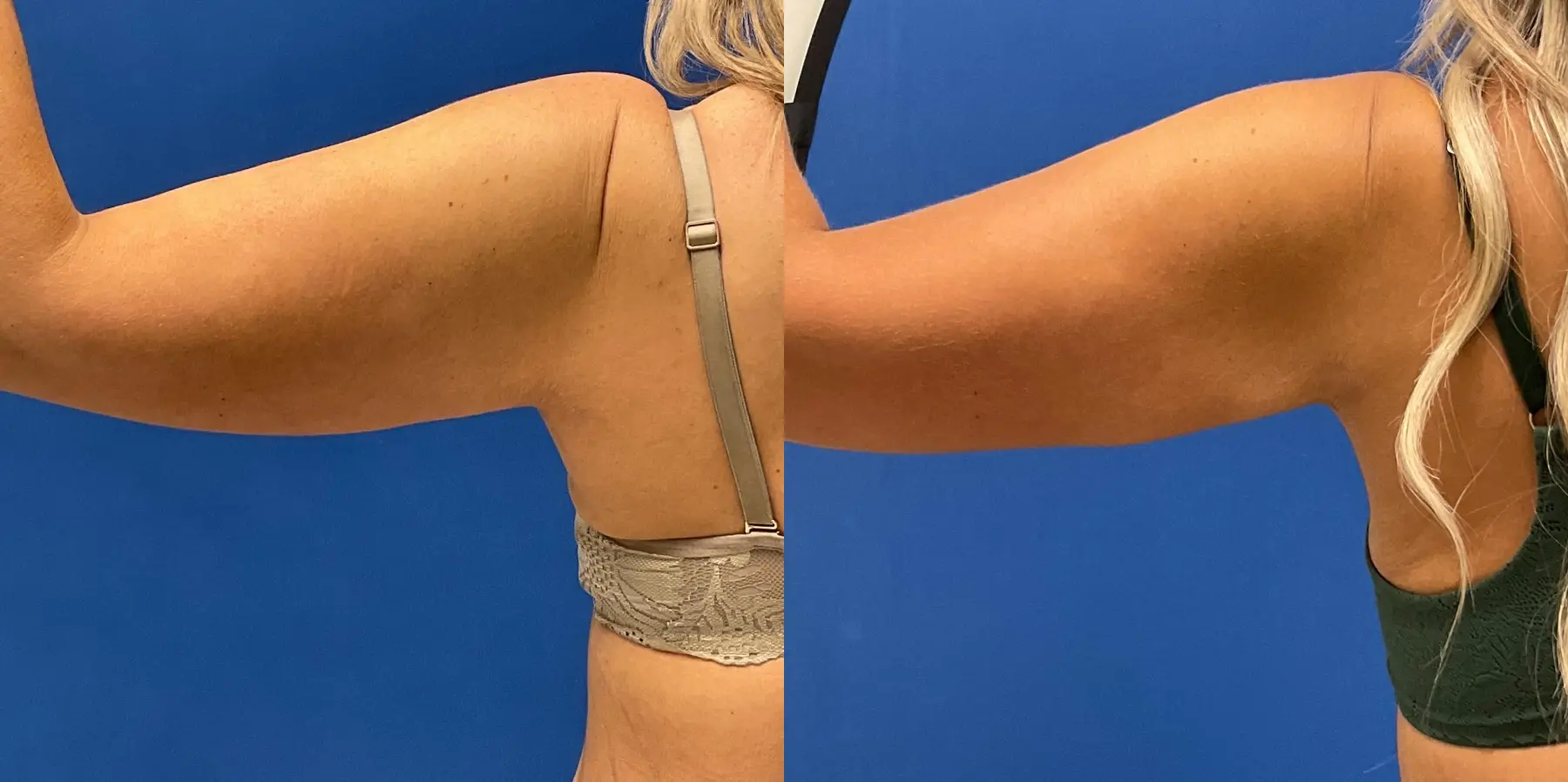 Skin Tightening: Patient 20 - Before and After 3