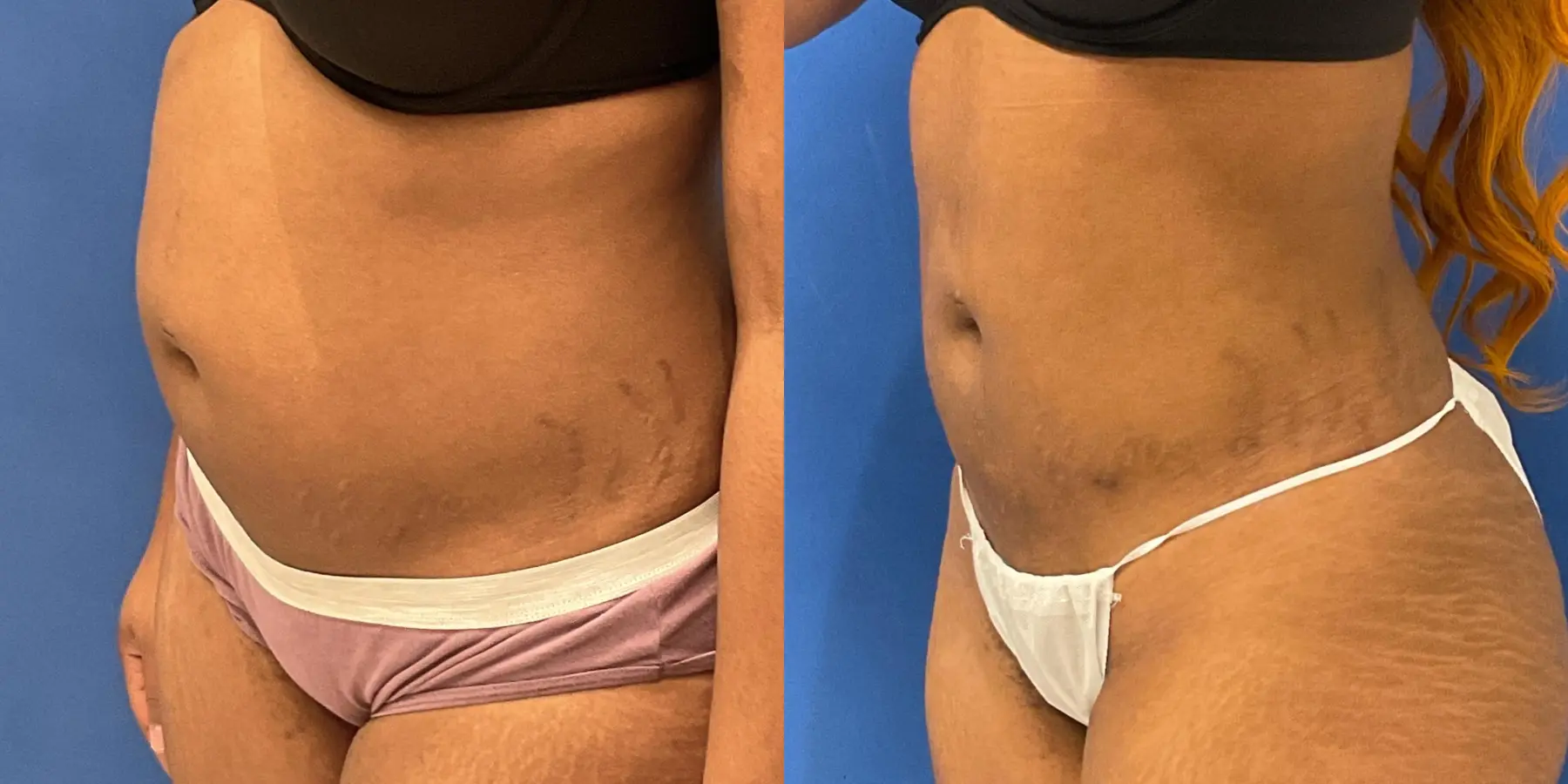 Skin Tightening: Patient 10 - Before and After 2
