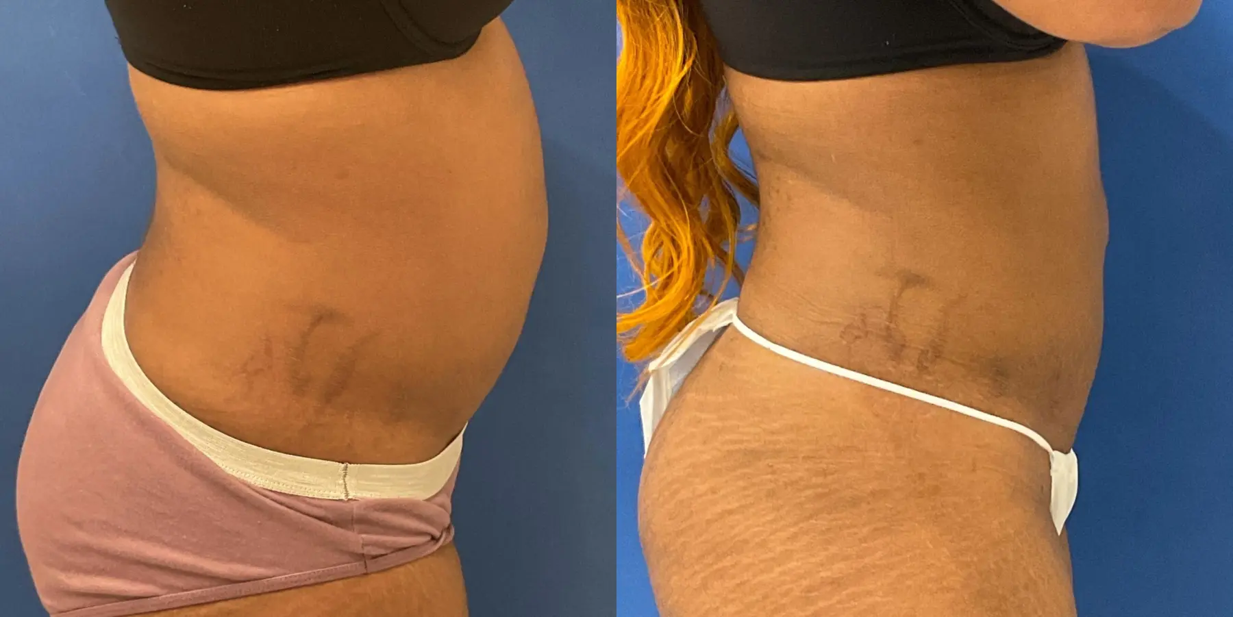 Skin Tightening: Patient 10 - Before and After 5