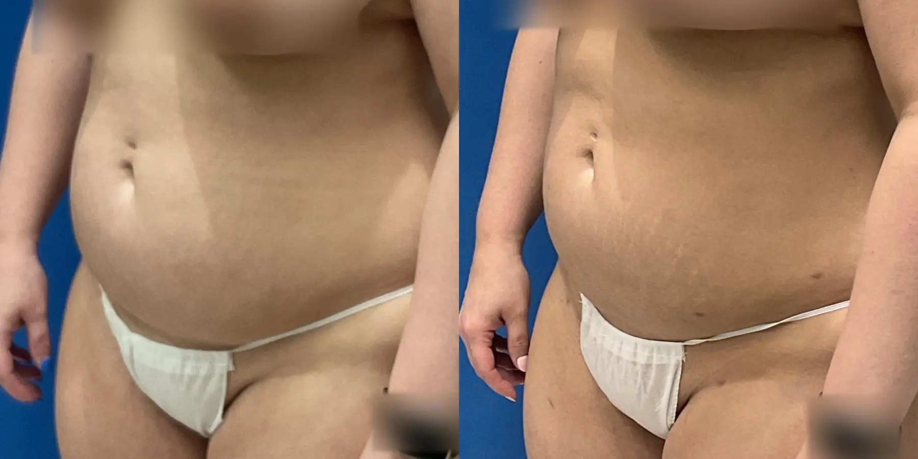 Skin Tightening: Patient 10 - Before and After 2