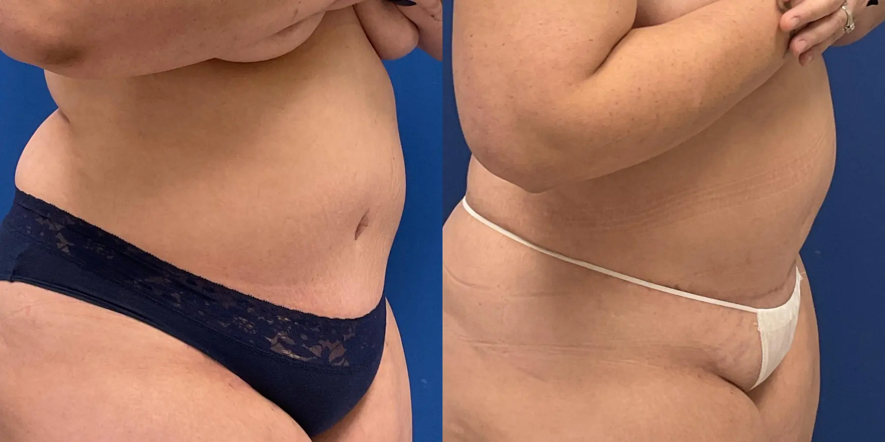 Skin Tightening: Patient 8 - Before and After 3