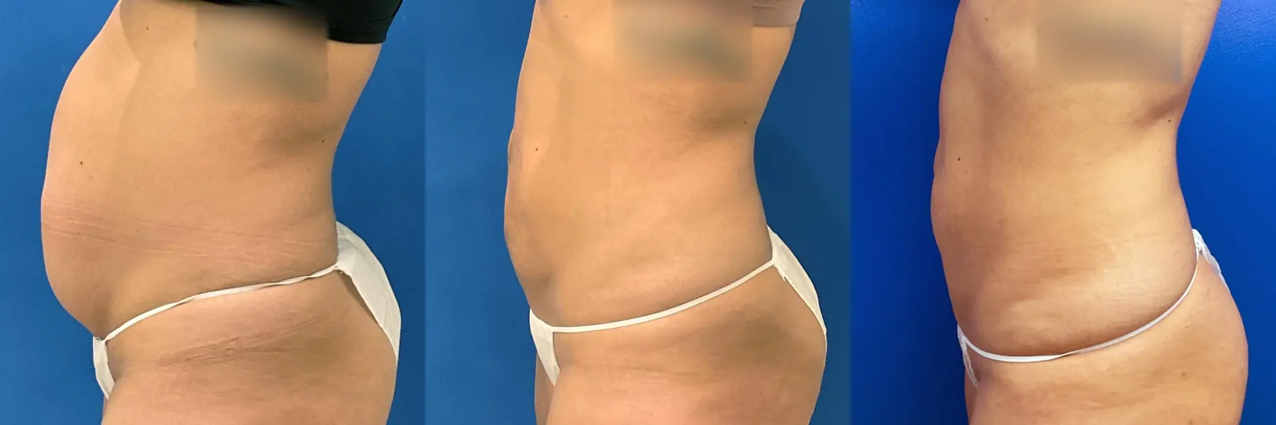 Skin Tightening: Patient 17 - Before and After 4