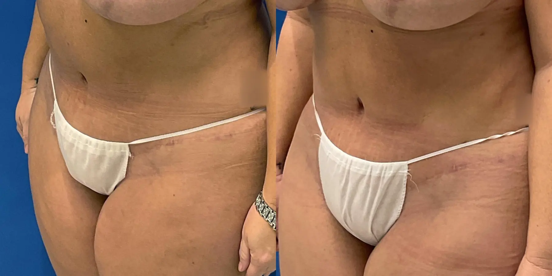 Skin Tightening: Patient 7 - Before and After 2