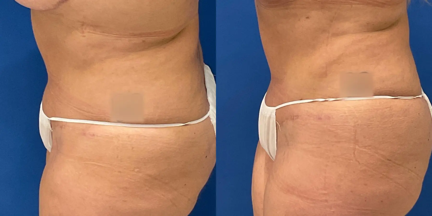 Skin Tightening: Patient 7 - Before and After 4