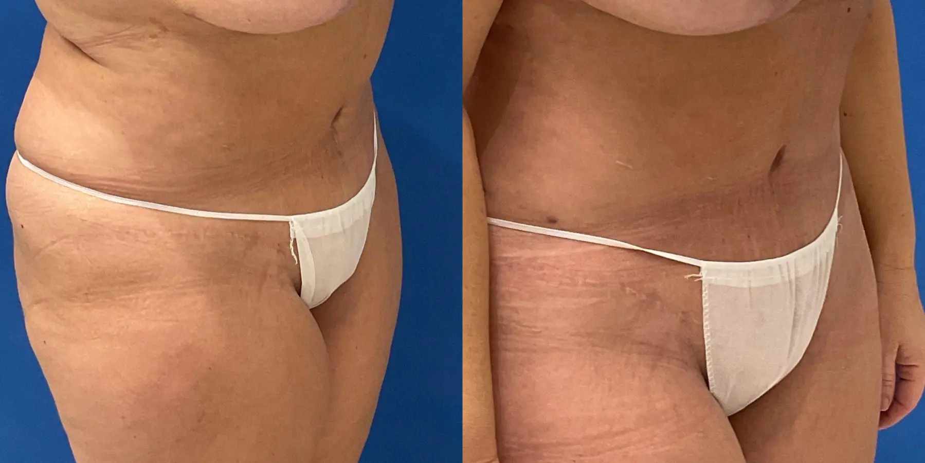 Skin Tightening: Patient 7 - Before and After 3