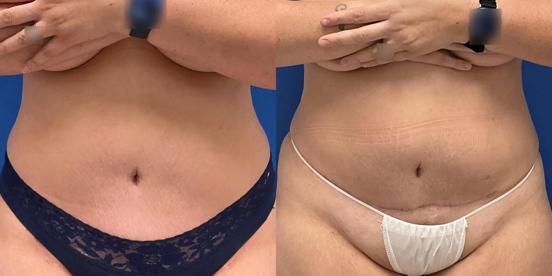 Skin Tightening: Patient 8 - Before and After  