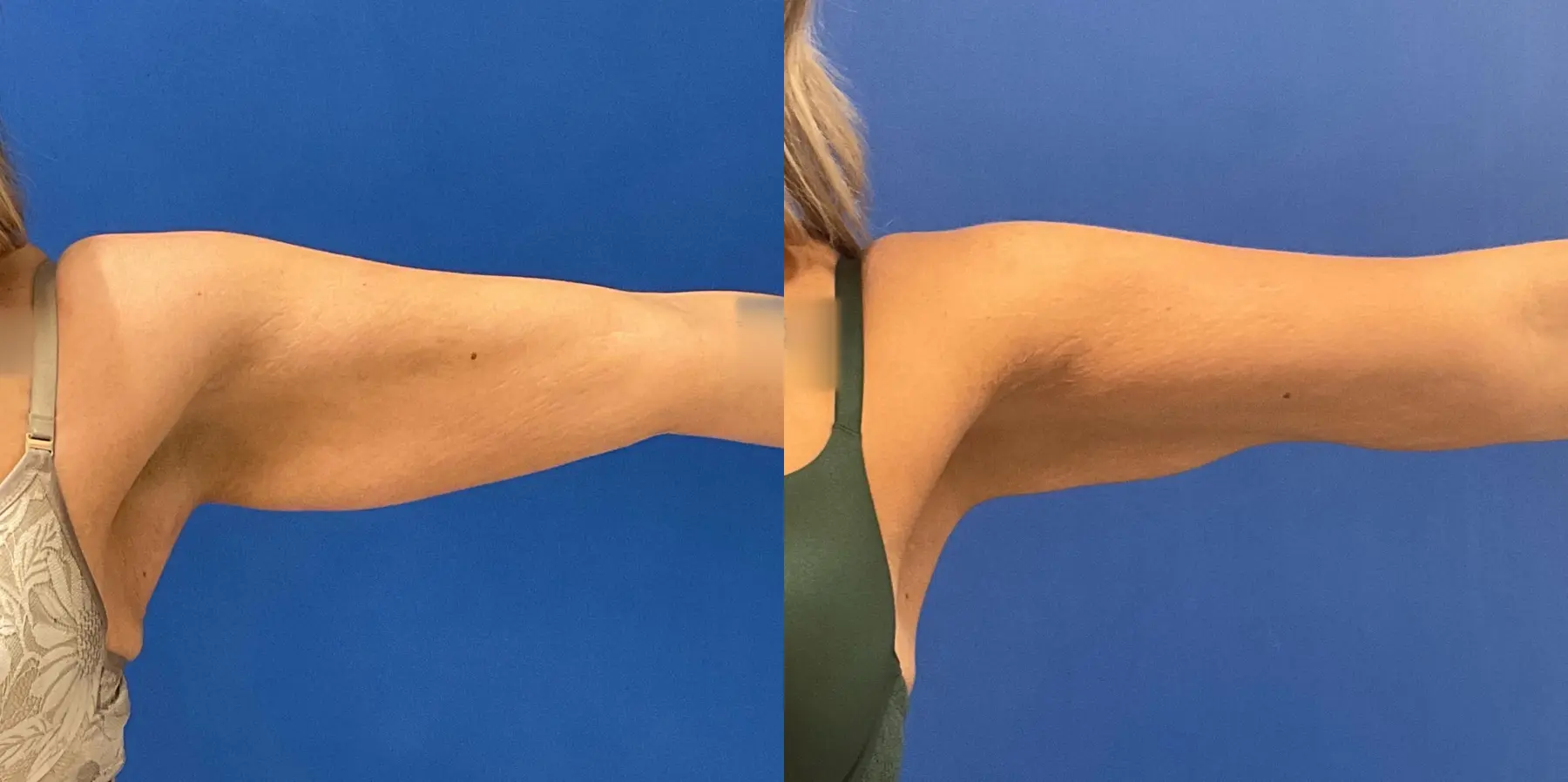 Skin Tightening: Patient 20 - Before and After  