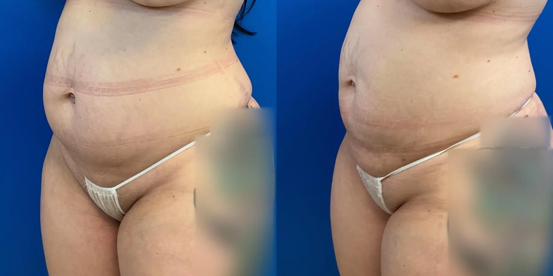 Skin Tightening: Patient 13 - Before and After 2