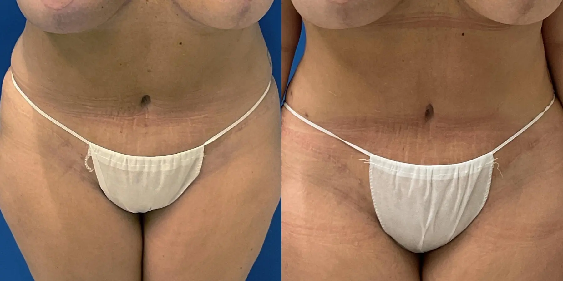 Skin Tightening: Patient 7 - Before and After  