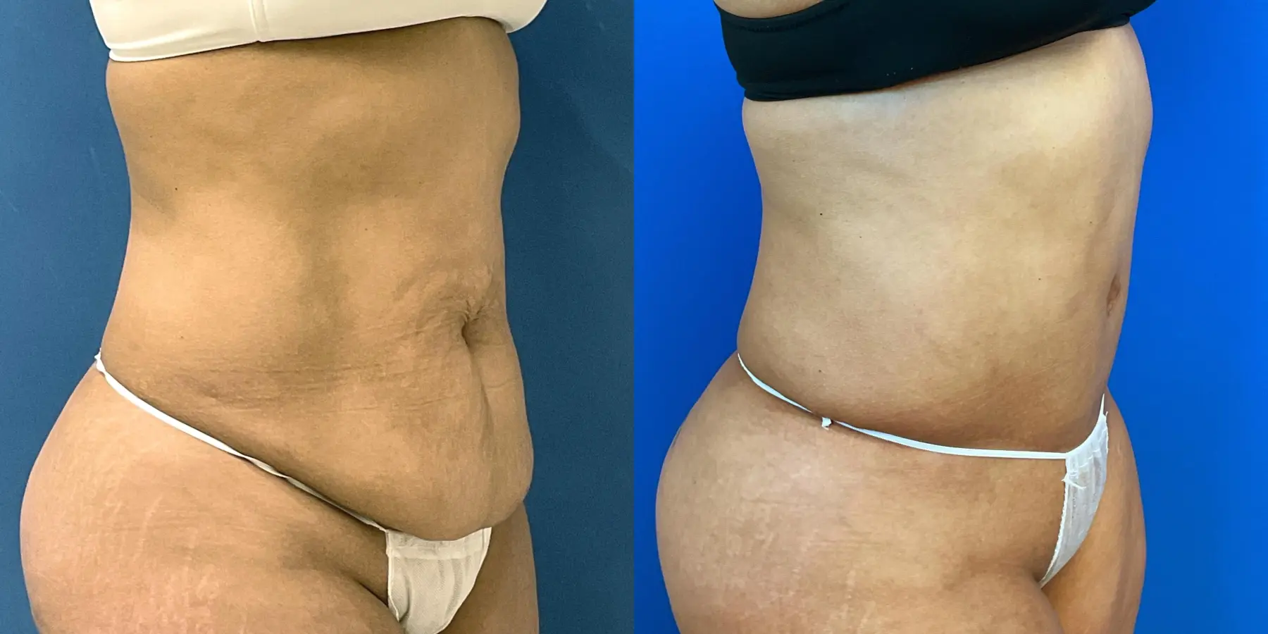 Tummy Tuck: Patient 31 - Before and After 3
