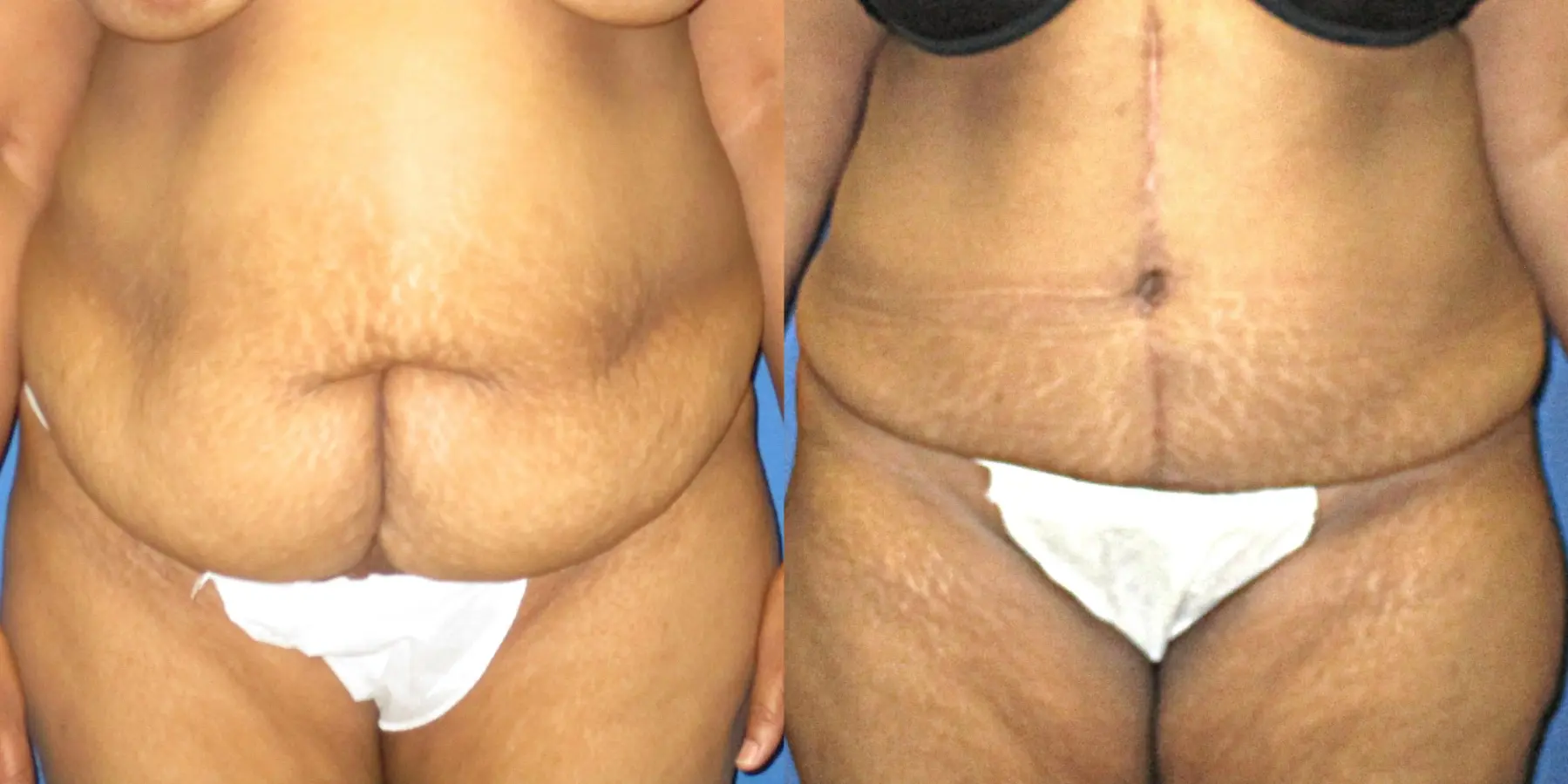 Tummy Tuck: Patient 12 - Before and After 1