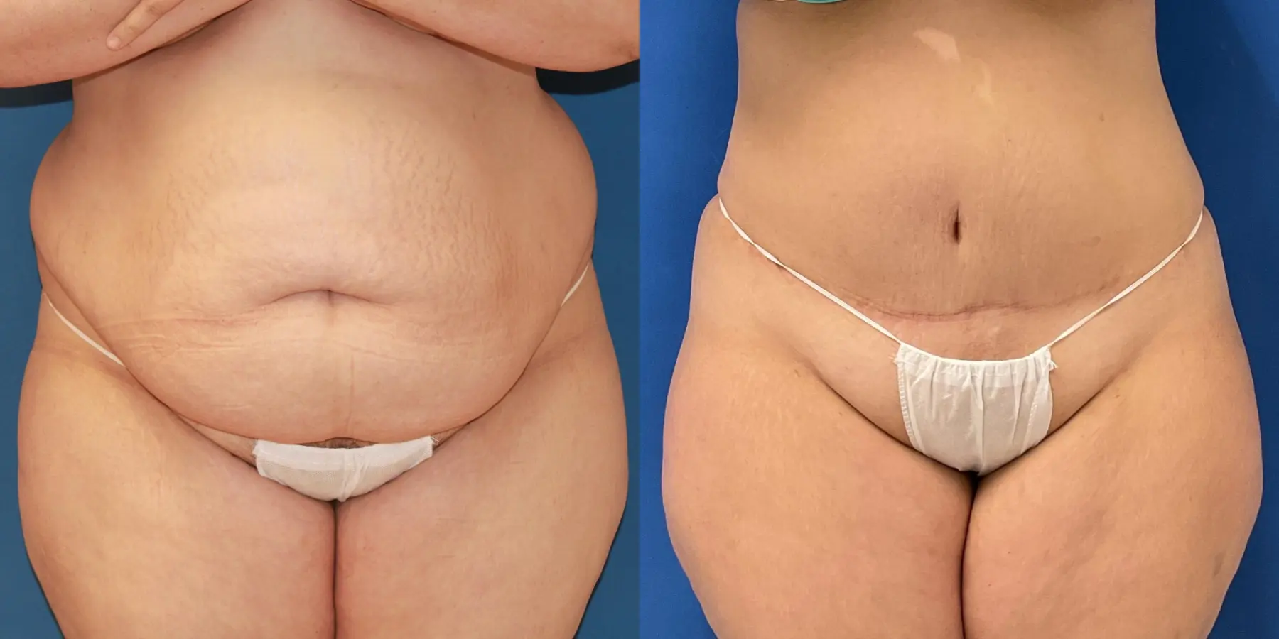 Tummy Tuck: Patient 9 - Before and After  