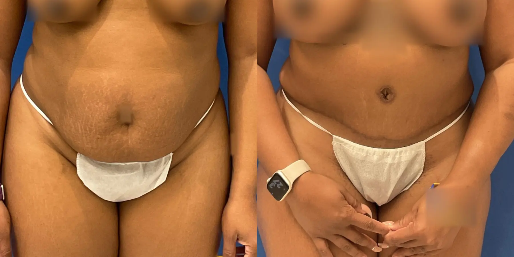 Tummy Tuck: Patient 2 - Before and After  