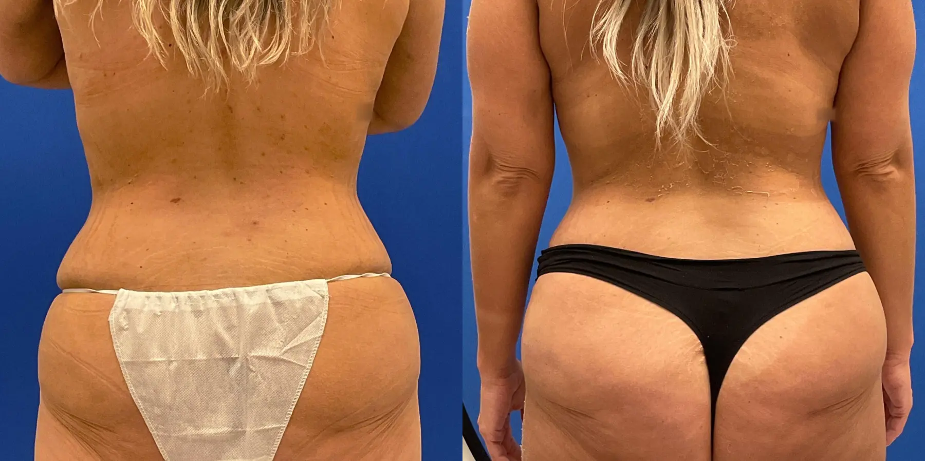 Tummy Tuck: Patient 34 - Before and After 6