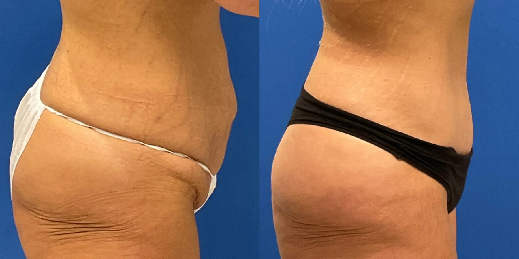 Tummy Tuck: Patient 34 - Before and After 5