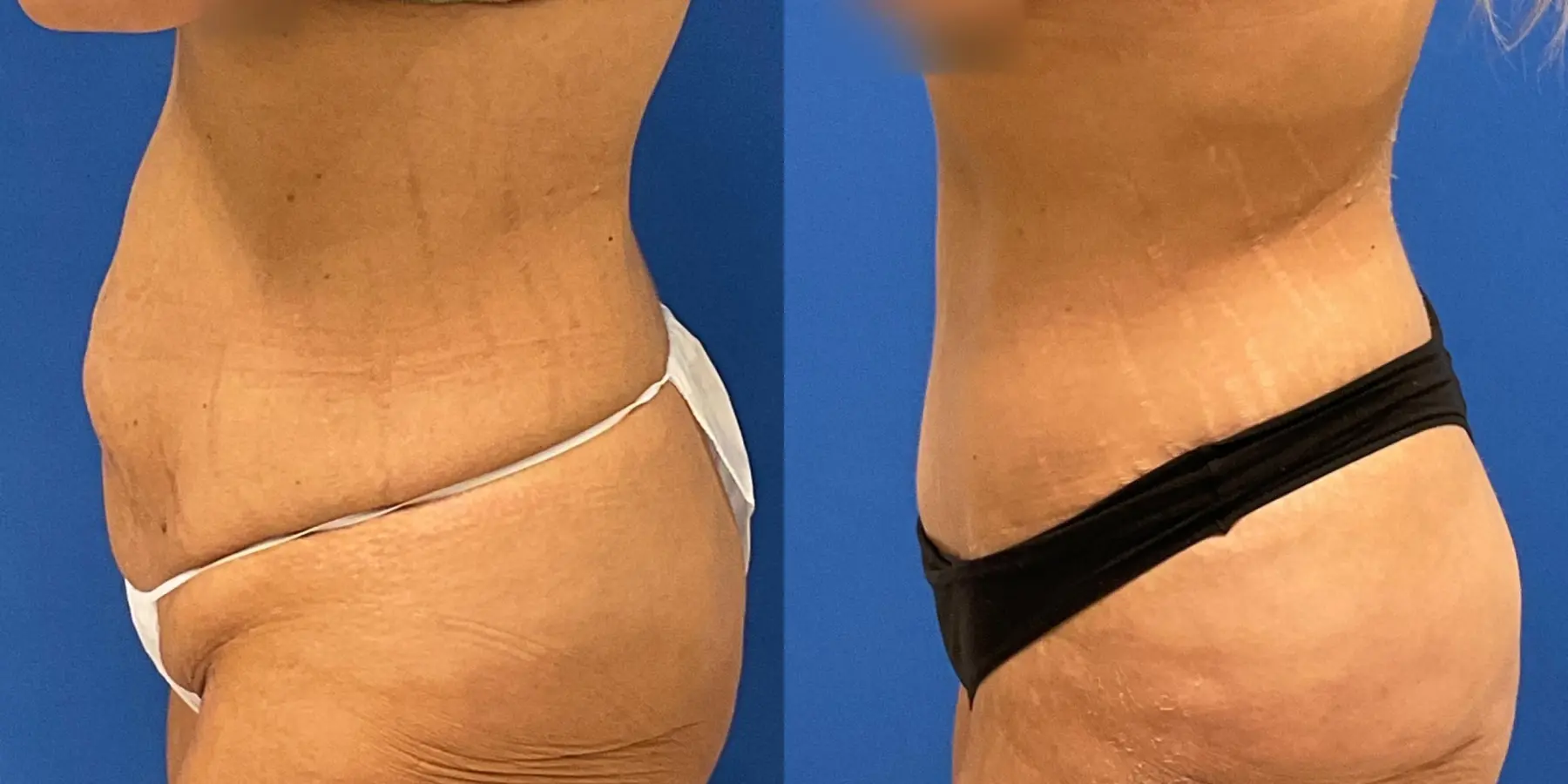 Tummy Tuck: Patient 34 - Before and After 4