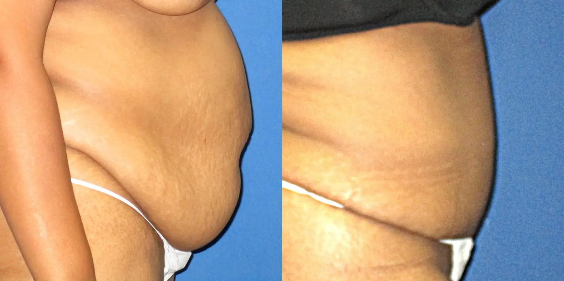 Tummy Tuck: Patient 12 - Before and After 2