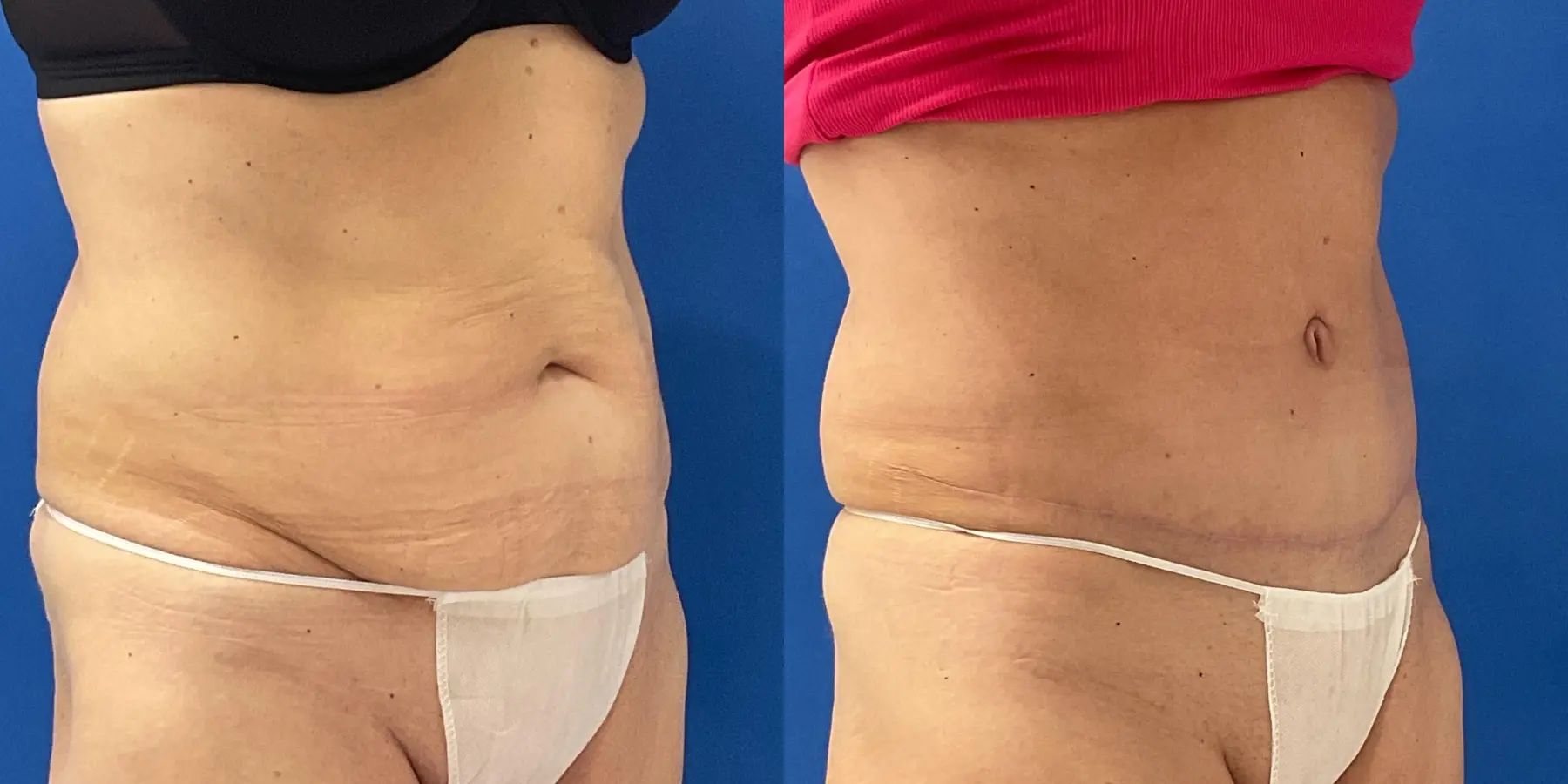 Tummy Tuck: Patient 33 - Before and After 3