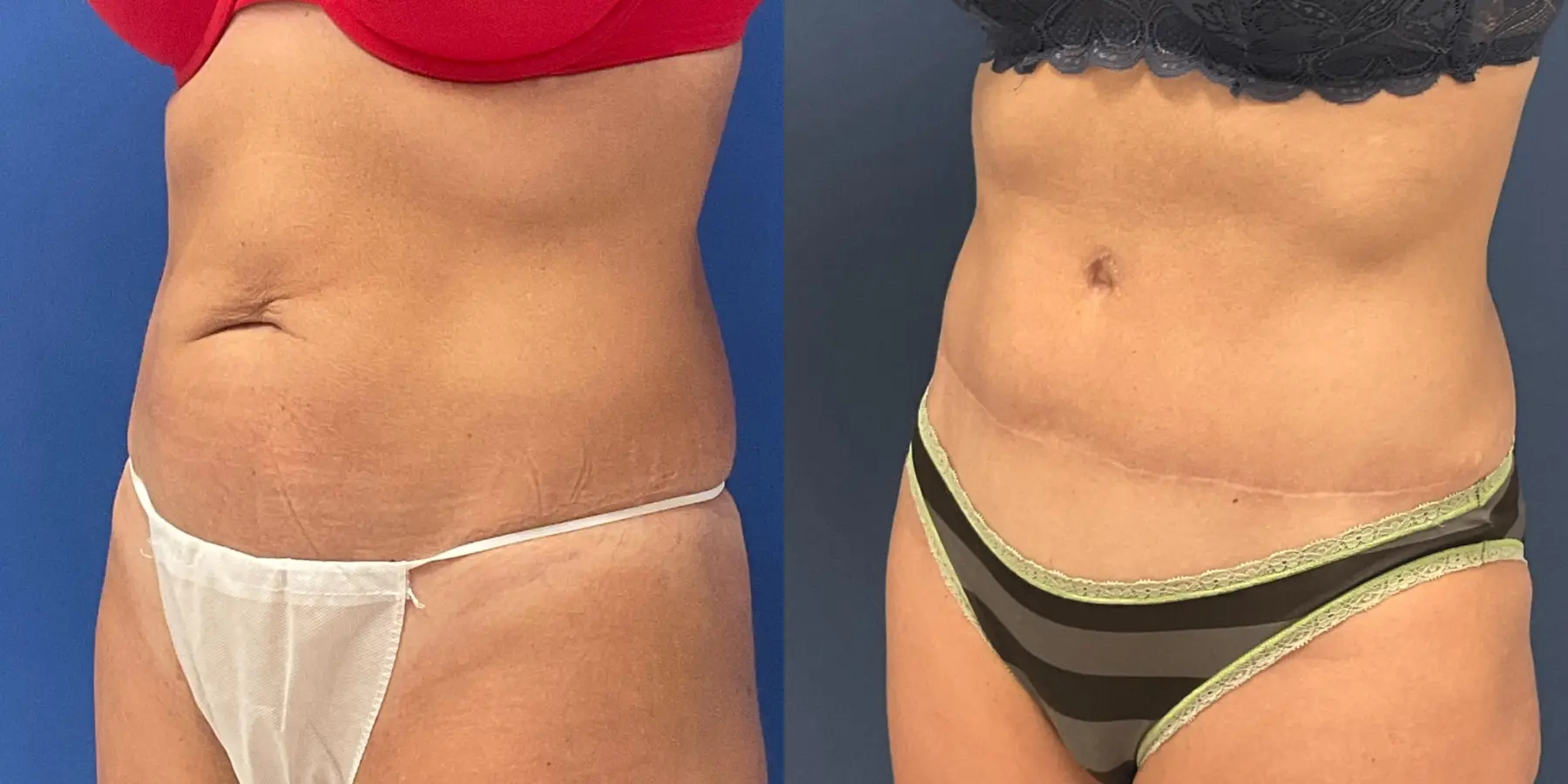 Tummy Tuck: Patient 15 - Before and After 2